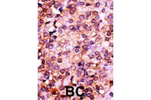 Formalin-fixed and paraffin-embedded human cancer tissue reacted with the primary antibody, which was peroxidase-conjugated to the secondary antibody, followed by AEC staining. (PANK3 抗体  (N-Term))