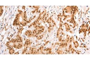 Immunohistochemistry of paraffin-embedded Human colon cancer tissue using TAX1BP1 Polyclonal Antibody at dilution 1:60 (TAX1BP1 抗体)