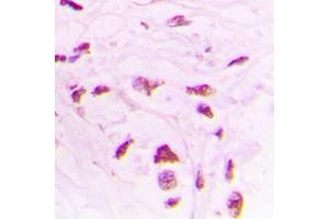 Immunohistochemical analysis of STK17B staining in human lung cancer formalin fixed paraffin embedded tissue section. (DRAK2 抗体  (Center))