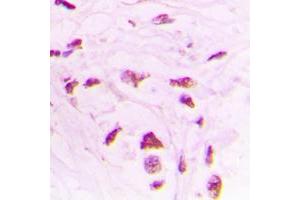 Immunohistochemical analysis of STK17B staining in human lung cancer formalin fixed paraffin embedded tissue section.