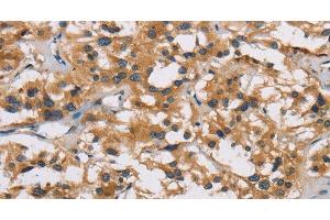 Immunohistochemistry of paraffin-embedded Human thyroid cancer using IL19 Polyclonal Antibody at dilution of 1:40 (IL-19 抗体)