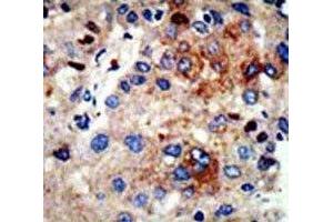 IHC analysis of FFPE human hepatocarcinoma stained with HDAC9 antibody (HDAC9 抗体  (AA 2-32))