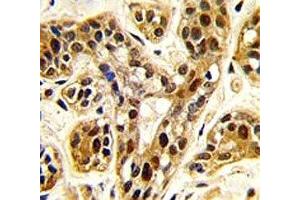 IHC analysis of FFPE human breast carcinoma tissue stained with PRMT1 antibody (PRMT1 抗体  (AA 317-346))
