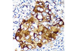 Immunohistochemistry of paraffin-embedded Human breast cancer using WIF1 Rabbit pAb (ABIN6128926, ABIN6150217, ABIN6150219 and ABIN6216799) at dilution of 1:100 (40x lens). (WIF1 抗体  (AA 29-220))