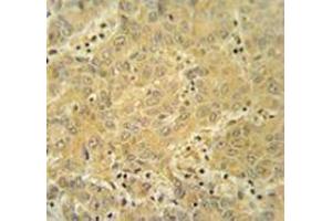 Immunohistochemistry analysis in human hepatocarcinoma tissue (Formalin-fixed, Paraffin-embedded) using CYP2A7  Antibody , followed by peroxidase conjugation of the secondary antibody and DAB staining. (CYP2A7 抗体  (Middle Region))