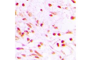 Immunohistochemical analysis of FOSL1 staining in human lung cancer formalin fixed paraffin embedded tissue section. (FOSL1 抗体  (Center))