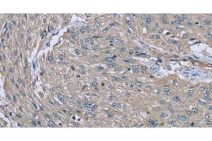 Immunohistochemistry of paraffin-embedded Human esophagus cancer using EZR Polyclonal Antibody at dilution of 1:30 (Ezrin 抗体)