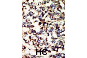 Formalin-fixed and paraffin-embedded human hepatocellular carcinoma tissue reacted with NEK7 polyclonal antibody  , which was peroxidase-conjugated to the secondary antibody, followed by DAB staining. (NEK7 抗体  (N-Term))