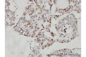 Immunoperoxidase of monoclonal antibody to MCFD2 on formalin-fixed paraffin-embedded human ovary, clear cell carcinoma.