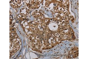 Immunohistochemistry of Human breast cancer using PNN Polyclonal Antibody at dilution of 1:50 (PNN 抗体)