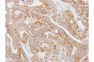 IHC-P Image Immunohistochemical analysis of paraffin-embedded N87 xenograft, using AP2M1, antibody at 1:100 dilution. (AP2M1 抗体  (Center))