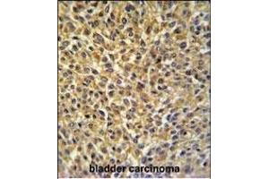 CRIP1 Antibody (C-term) (ABIN650905 and ABIN2839990) IHC analysis in formalin fixed and paraffin embedded bladder carcinoma followed by peroxidase conjugation of the secondary antibody and DAB staining. (CRIP1 抗体  (C-Term))