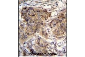 TTC9C Antibody (N-term) (ABIN655122 and ABIN2844752) immunohistochemistry analysis in formalin fixed and paraffin embedded human breast carcinoma followed by peroxidase conjugation of the secondary antibody and DAB staining. (TTC9C 抗体  (N-Term))