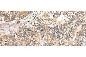 Immunohistochemistry of paraffin-embedded Human gastric cancer tissue using BCHE Polyclonal Antibody at dilution of 1:40(x200) (Butyrylcholinesterase 抗体)