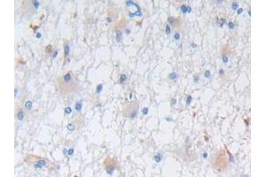 DAB staining on IHC-P; Samples: Human Glioma Tissue (Nestin 抗体  (AA 178-399))