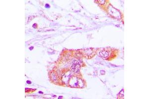 Immunohistochemical analysis of Apolipoprotein E staining in human lung cancer formalin fixed paraffin embedded tissue section. (APOE 抗体  (Center))