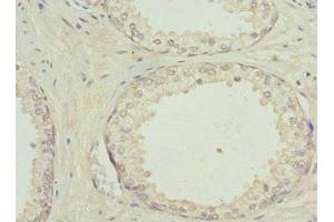 Immunohistochemistry of paraffin-embedded human prostate cancer using ABIN7154206 at dilution of 1:100 (PYGB 抗体  (AA 6-843))