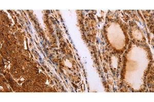Immunohistochemistry of paraffin-embedded Human thyroid cancer tissue using SLC9A3R2 Polyclonal Antibody at dilution 1:40 (SLC9A3R2 抗体)