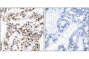 Immunohistochemistry analysis of paraffin-embedded human breast carcinoma tissue, using MYC (Ab-58) Antibody. (c-MYC 抗体  (AA 25-74))