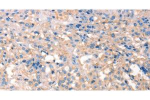 Immunohistochemistry of paraffin-embedded Human thyroid cancer using PRPS1/2/PRPS1L1 Polyclonal Antibody at dilution of 1:30 (PRPS1/2/1L1 抗体)