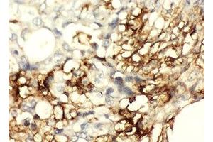 IHC-P: CD44 antibody testing of human intestinal cancer tissue (CD44 抗体  (C-Term))