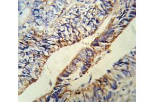 Anti-PCSK9 antibody IHC analysis in formalin fixed and paraffin embedded human colon carcinoma.