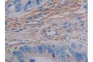 Detection of FLNC in Human Colorectal cancer Tissue using Polyclonal Antibody to Filamin C Gamma (FLNC)