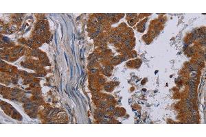 Immunohistochemistry of paraffin-embedded Human esophagus cancer tissue using NECTIN3 Polyclonal Antibody at dilution 1:40 (nectin-3 抗体)