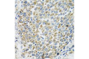 Immunohistochemistry of paraffin-embedded human lung cancer using TXN2 antibody (ABIN2560616) at dilution of 1:100 (40x lens). (TXN2 抗体)