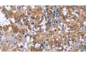 Immunohistochemistry of paraffin-embedded Human thyroid cancer using IL2RB Polyclonal Antibody at dilution of 1:30 (IL2 Receptor beta 抗体)