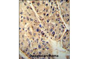 ABCD1 antibody immunohistochemistry analysis in formalin fixed and paraffin embedded human hepatocarcinoma followed by peroxidase conjugation of the secondary antibody and DAB staining. (ABCD1 抗体  (AA 257-285))