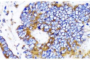 Immunohistochemistry of paraffin-embedded Human colon carcinoma using MRPL13 Polyclonal Antibody at dilution of 1:100 (40x lens). (MRPL13 抗体)