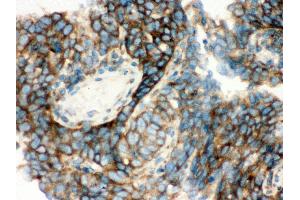 Anti- YB1 Picoband antibody,IHC(P) IHC(P): Human Lung Cancer Tissue (YBX1 抗体  (C-Term))