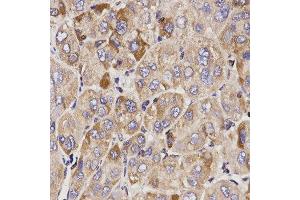 Immunohistochemistry of paraffin-embedded human liver cancer tissue using GAS2 antibody at dilution of 1:200 (x400 lens) (GAS2 抗体)