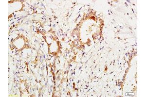 Formalin-fixed and paraffin embedded human breast cancer labeled with Anti-CA153/MUC1/KL-6 Polyclonal Antibody, Unconjugated  at 1:200 followed by conjugation to the secondary antibody and DAB staining. (MUC1 抗体  (AA 1101-1255))