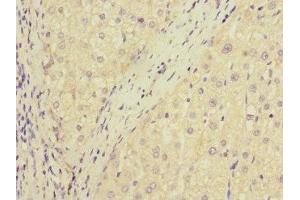 Immunohistochemistry of paraffin-embedded human liver cancer using ABIN7150741 at dilution of 1:100 (DUSP1 抗体  (AA 1-300))