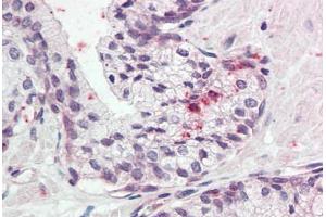 Human Prostate (formalin-fixed, paraffin-embedded) stained with KLK11 antibody ABIN337038 at 5 ug/ml followed by biotinylated goat anti-rabbit IgG secondary antibody ABIN481713, alkaline phosphatase-streptavidin and chromogen. (Kallikrein 11 抗体  (AA 68-82))