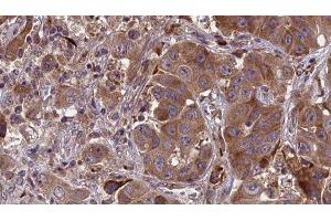ABIN6277654 at 1/100 staining Human liver cancer tissue by IHC-P. (MLKL 抗体  (Internal Region))