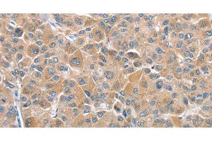 Immunohistochemistry of paraffin-embedded Human liver cancer tissue using CHMP4B Polyclonal Antibody at dilution 1:40 (CHMP4B 抗体)