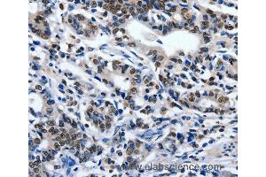 Immunohistochemistry of Human gastic cancer using ENPP3 Polyclonal Antibody at dilution of 1:80 (ENPP3 抗体)