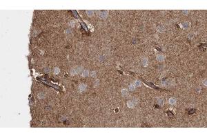 ABIN6273483 at 1/100 staining Human brain cancer tissue by IHC-P. (MAP4K2 抗体  (Internal Region))