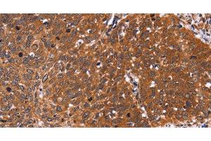 Immunohistochemistry of paraffin-embedded Human cervical cancer tissue using CDC37L1 Polyclonal Antibody at dilution 1:60 (CDC37L1 抗体)