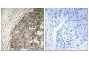Immunohistochemistry analysis of paraffin-embedded human breast carcinoma tissue using CSGALNACT1 antibody. (CSGALNACT1 抗体)