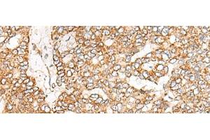 Immunohistochemistry of paraffin-embedded Human liver cancer tissue using NME4 Polyclonal Antibody at dilution of 1:45(x200) (NME4 抗体)