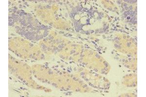 Immunohistochemistry of paraffin-embedded human gastric cancer using ABIN7166957 at dilution of 1:100 (GDI2 抗体  (AA 1-445))