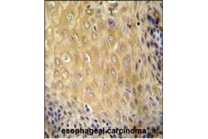 C6orf70 antibody (Center) (ABIN654987 and ABIN2844625) immunohistochemistry analysis in formalin fixed and paraffin embedded human esophageal carcinoma followed by peroxidase conjugation of the secondary antibody and DAB staining. (C6orf70 抗体  (AA 346-375))