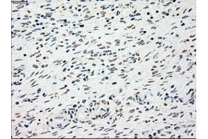 Immunohistochemical staining of paraffin-embedded liver tissue using anti-CHEK2mouse monoclonal antibody. (CHEK2 抗体)