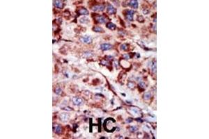 Formalin-fixed and paraffin-embedded human cancer tissue reacted with the primary antibody, which was peroxidase-conjugated to the secondary antibody, followed by AEC staining. (Adenylate Kinase 2 抗体  (C-Term))