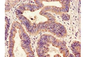 Immunohistochemistry of paraffin-embedded human colon cancer using ABIN7155869 at dilution of 1:100 (HIPK3 抗体  (AA 841-1130))