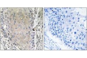 Immunohistochemistry analysis of paraffin-embedded human lung carcinoma tissue, using CBLN3 Antibody. (CBLN3 抗体  (AA 131-180))
